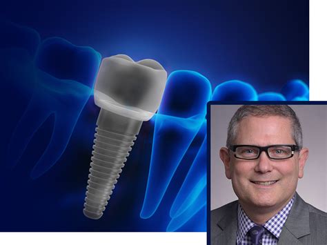 adin implants|adin implants usa.